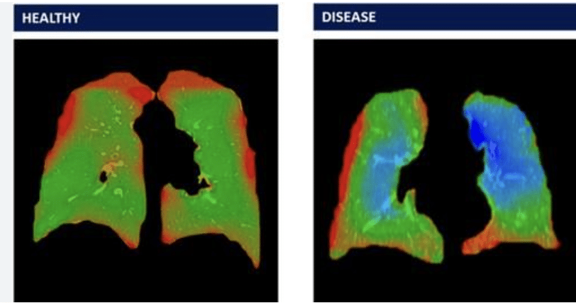 Is The 4D Medical (ASX: 4DX) Share Price Overhyped?