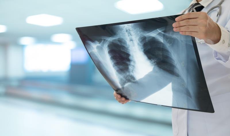More than 1 in 5 new TB cases in Europe are missed, analysis finds