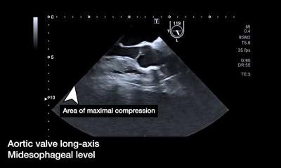 Real-time imaging turns CPR into precision procedure • healthcare-in-europe.com