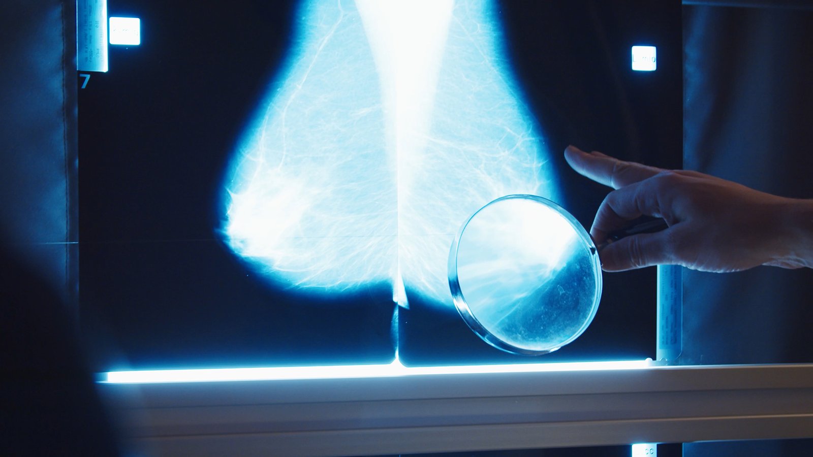 The importance of breast density monitoring