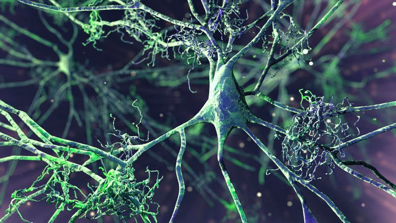 New EU Push to Speed Alzheimer's Diagnosis, Treatment