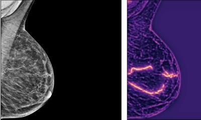 AI predicts heart disease risk from mammograms • healthcare-in-europe.com